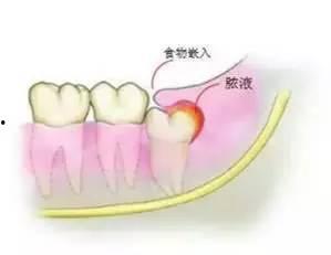 拔智齿吃瓜,一场吃瓜盛宴的诞生