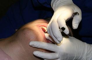 拔智齿吃瓜,一场吃瓜盛宴的诞生