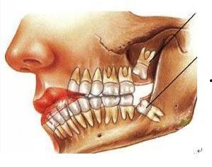 拔智齿吃瓜,一场吃瓜盛宴的诞生